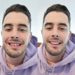 2x1 Carillas Dentales: La Solución Perfecta para una Sonrisa Impecable