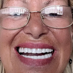 2x1 Carillas Dentales: La Solución Perfecta para una Sonrisa Impecable